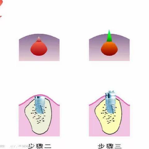 种植牙术后注意事项