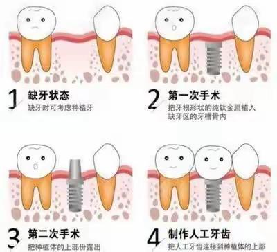 种植牙流程术中