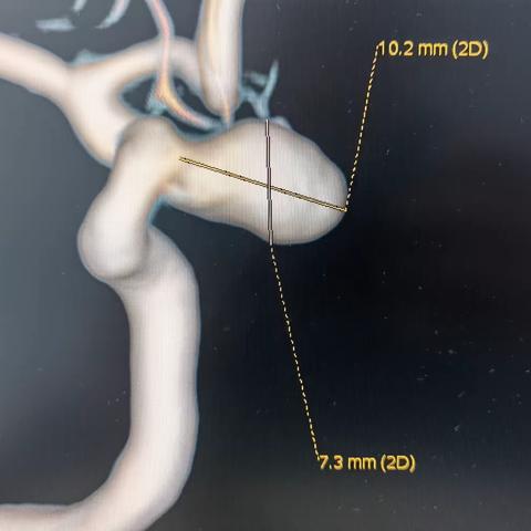 右颈动脉瘤 支架辅助栓塞