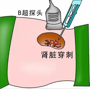 肾穿刺围手术期的护理