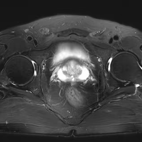 后入路结合VIP技术腹腔镜下根治性前列腺切除术
