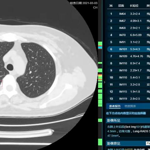 人工智能助力低剂量CT筛查，让肺结节无处遁形