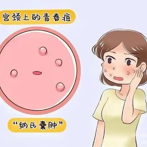 宫颈上的“青春痘”——宫颈纳囊