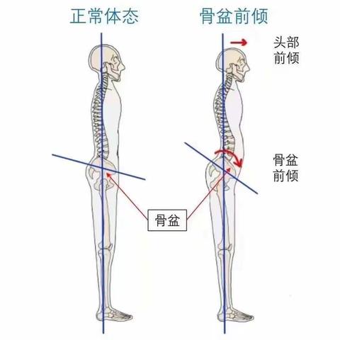 什么是骨盆前倾