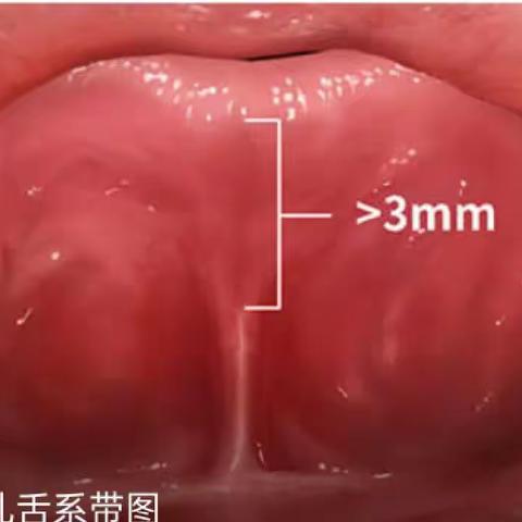 舌系带矫正术的护理——五官科