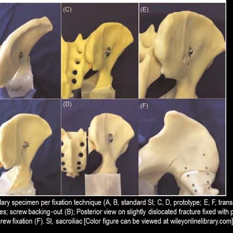 骶髂螺钉第二部分 sacroiliac screw fixation