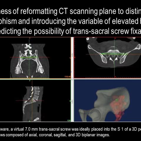 骶髂螺钉第三部分 sacroiliac screw fixation