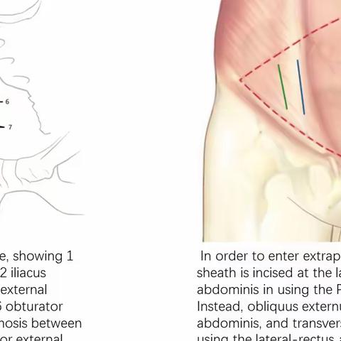 骨盆髋臼骨折之腹直肌外侧入路
