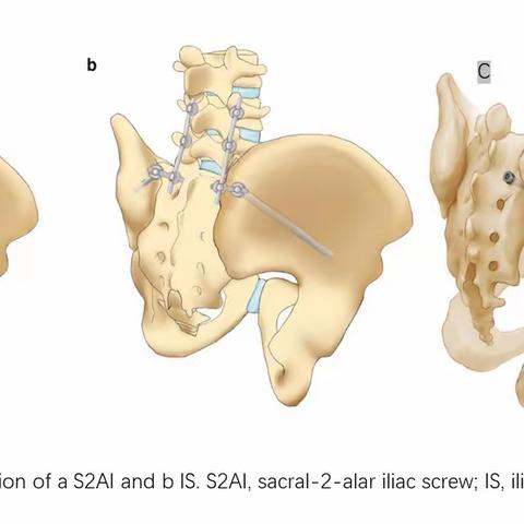 S2 A1 screw